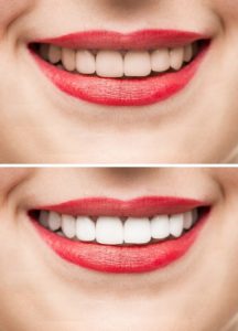 Teeth Whitening before and after treatment