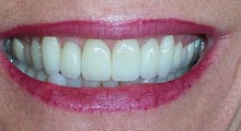 After cosmetic dentist treatment