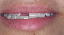 Before dental implant