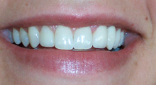 After teeth whitening