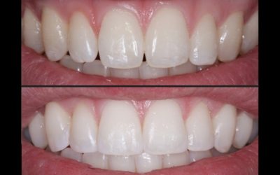 Composite bonding before and after treatment