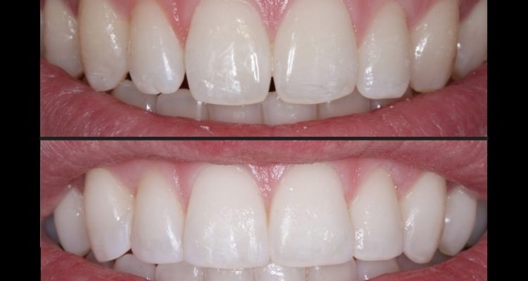 Composite bonding before and after treatment