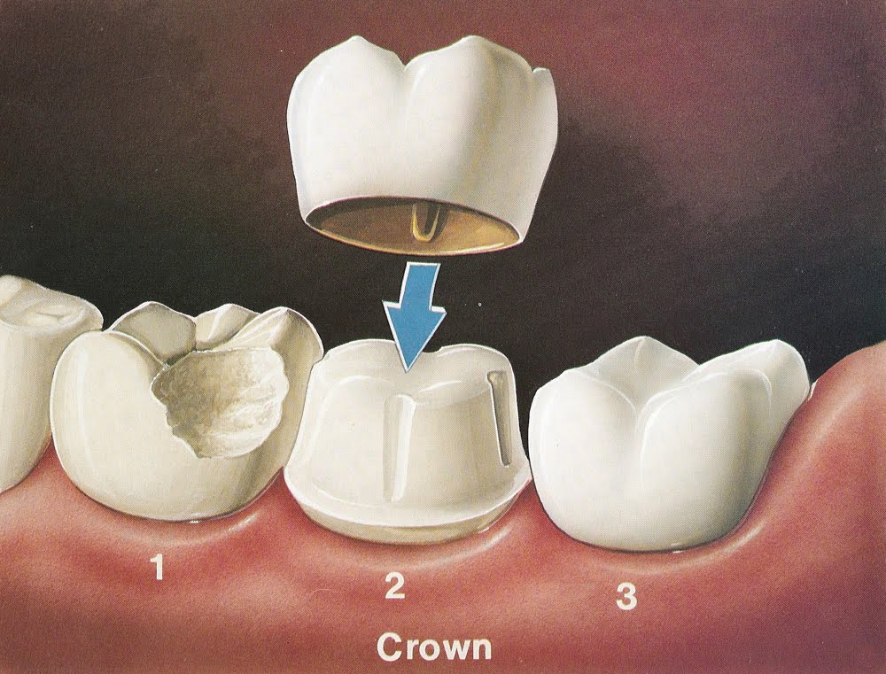 crown procedure albuquerque