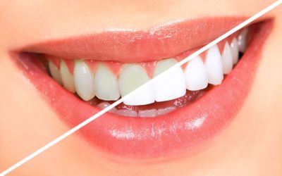 5 Things to Learn About Teeth Whitening Procedure