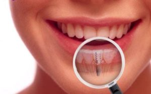 Dental Implants – Your Key to a Perfect and Healthy Smile