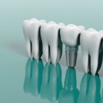 The Importance of Replacing Missing Teeth