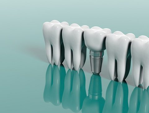The Importance of Replacing Missing Teeth