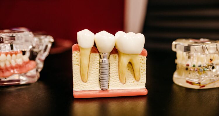 Show Off Your Smile With Dental Implants!