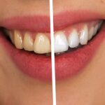 Teeth whitening in Albuquerque