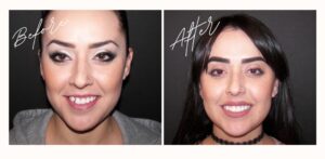 Invisalign before and after